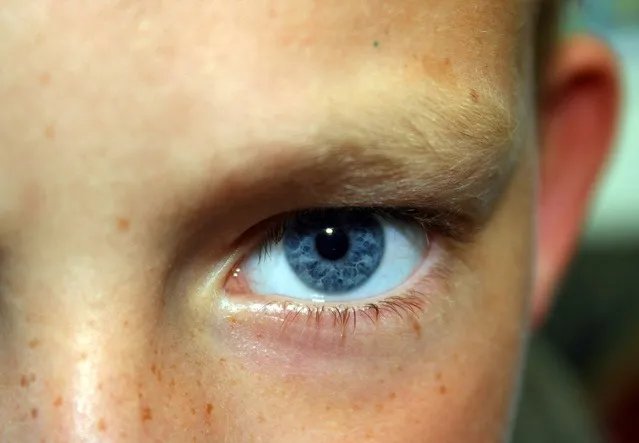 בדיקת עיניים לאבחון עין עצלה