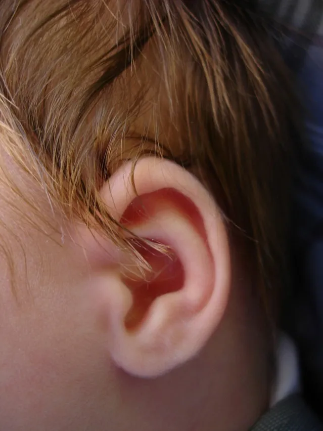 אוזן של פעוט לאחר ניתוח כפתורים